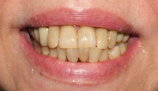 Paciente con enfermedad periodontal no tratable, los dientes aparecen largos y desplazados