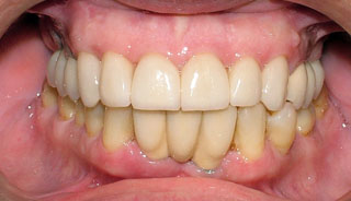 Después de extraer sus dientes y realizar implantes dentales