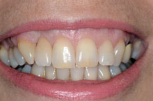El diente perfectamente integrado entre las piezas naturales