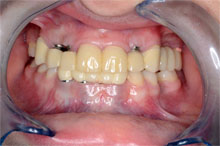 Colocamos implantes y prótesis provisionales