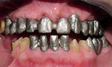Realizamos implantes y coronas donde fue posible conservar sus piezas 