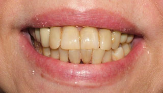 Paciente con enfermedad periodontal no tratable, los dientes aparecen largos y desplazados
