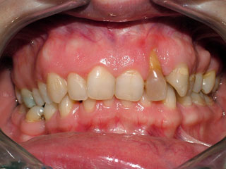 Paciente con los dientes mal alineados y un incisivo lateral no tratable