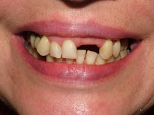 Ausencia de dos incisivos que solucionaremos con un solo implante