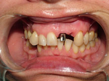 El implante colocado y su pilar