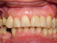 La prótesis sobre implante perfectamente integrada