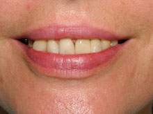 El aspecto final de la sonrisa