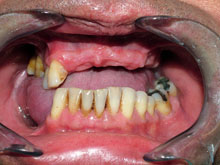 Un caso con gran reabsorción ósea en maxilar superior