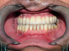 Realizamos implantes y prótesis