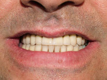 Logramos una sonrisa satisfactoria a pesar del defecto de tejidos