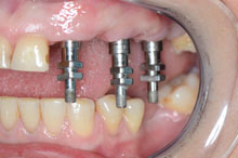 Tres implantes para sustituir 5 piezas