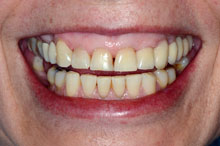 El puente sobre implantes colocado