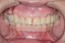 Las piezas protésicas parecen naturales