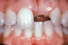 Ausencia del incisivo central superior izquierdo