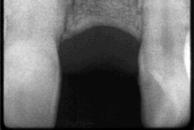 Aspecto radiológico de la zona edéntula