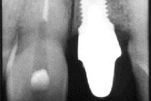 El implante colocado con el pilar conectado