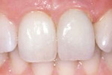 El caso finalizado. Ambos incisivos parecen naturales