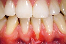 Recesión gingival en incisivo 31