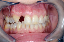 Ausencia de incisivo lateral con importante defecto óseo que precisa injerto