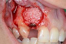 Cirugía de implante e injerto óseo