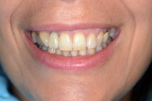 Prótesis provisional para modelar los tejidos 