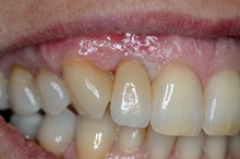 Caso terminado con recuperación de tejidos duros y blandos