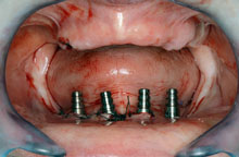 Cuatro implantes en la zona del mentón
