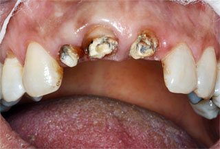 Dientes anteriores destruidos por caries