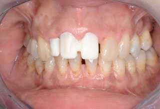 Probamos los núcleos de Zirconio para las coronas