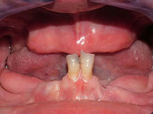 Paciente que sólo conservaba dos dientes en maxilar inferior