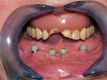 Extraemos los dientes y realizamos 4 implantes