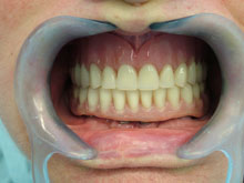 Nueva prótesis completa superior y prótesis sobre implantes inferior