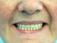 Caso finalizado. Aspecto natural y paciente satisfecha