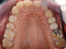 Desgastes en maxilar superior