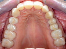 El maxilar superior con su anatomía oclusal restaurada