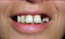 En sonrisa vemos un aspecto de dientes prominentes
