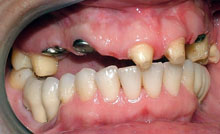 Realizamos implantes en las zonas edéntulas